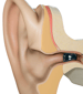 耳道内IIC挿入位置イメージ
